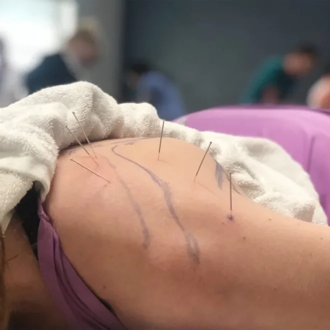 Learn Dry Needling (SFDN1):  Washington, D.C., WA